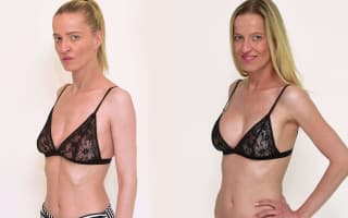 Breast up-lift