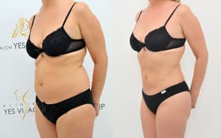 SlimLipo