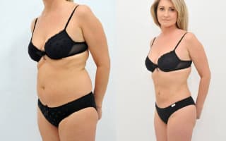 SlimLipo