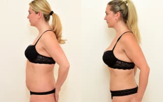 SlimLipo