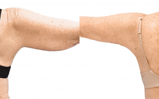 SlimLipo