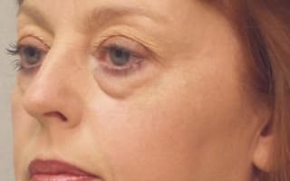 Bags and circles under the eyes