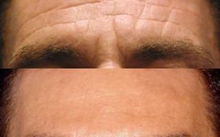 Brow and eyebrows