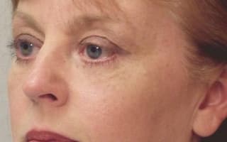 Bags and circles under the eyes