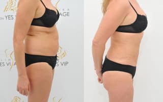 SlimLipo