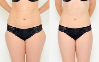 SlimLipo