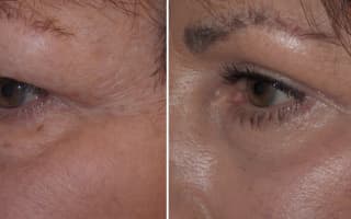 Bags and circles under the eyes
