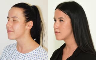 Nose surgery