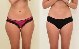SlimLipo