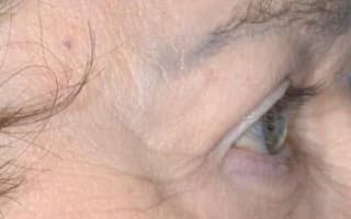 Bags and circles under the eyes