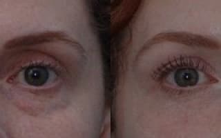 Bags and circles under the eyes