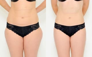 SlimLipo