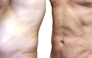 SlimLipo