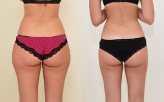 SlimLipo