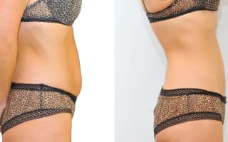 SlimLipo