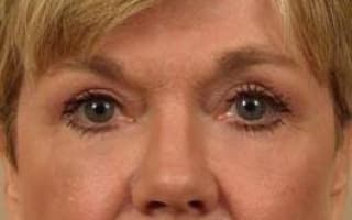 Bags and circles under the eyes