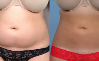 SlimLipo