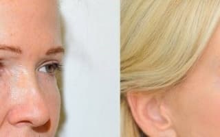 Eyelids