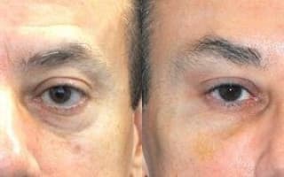 Bags and circles under the eyes