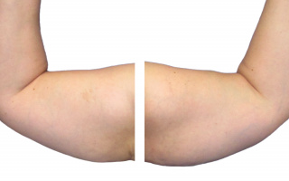 SlimLipo