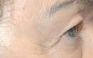 Bags and circles under the eyes