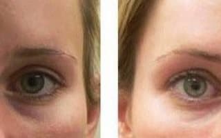 Bags and circles under the eyes