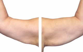 SlimLipo