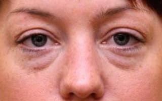 Bags and circles under the eyes