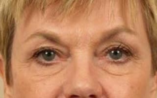 Bags and circles under the eyes