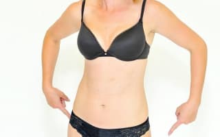 Breast Autoaugmentation