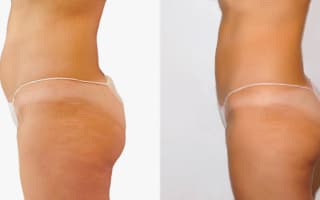 SlimLipo