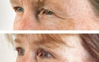 Eyelids