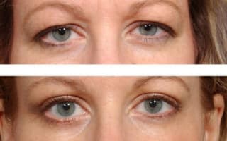 Eyelids