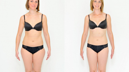 Breast Autoaugmentation