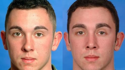 Nose surgery