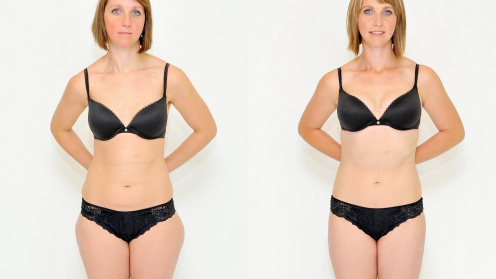Breast Autoaugmentation