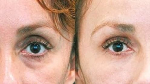 Bags and circles under the eyes