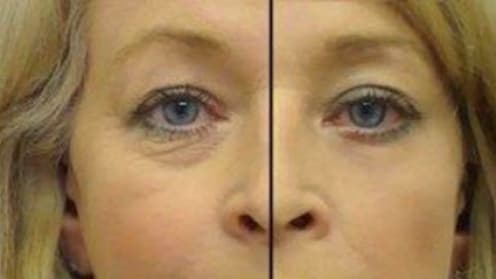 Bags and circles under the eyes