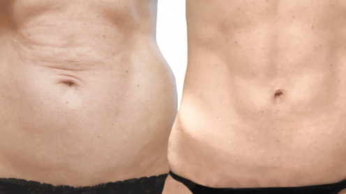 SlimLipo