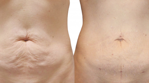 SlimLipo