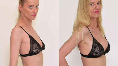 Breast up-lift