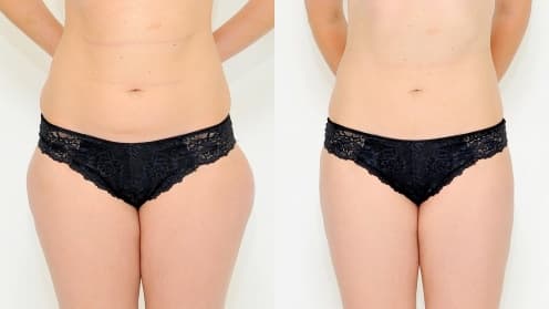 Breast Autoaugmentation