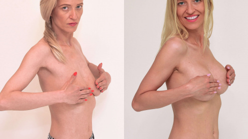 Breast up-lift