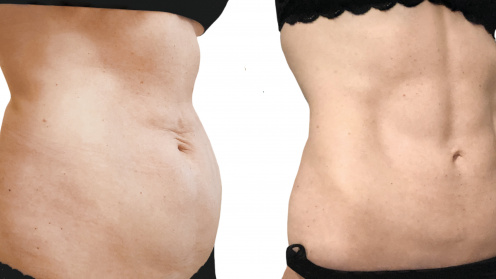 SlimLipo