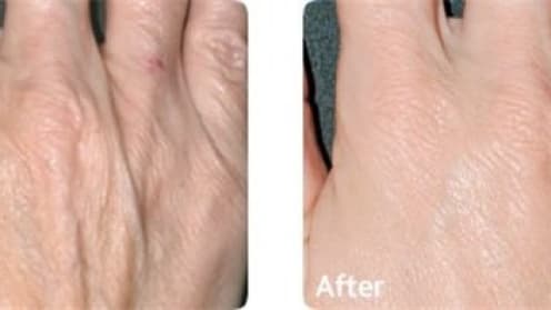 Mesotherapy