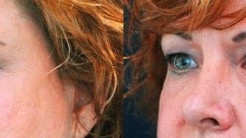 Bags and circles under the eyes