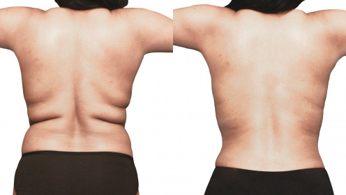 SlimLipo