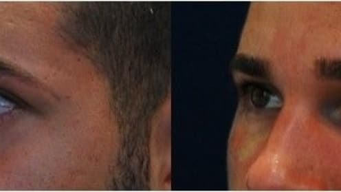 Bags and circles under the eyes