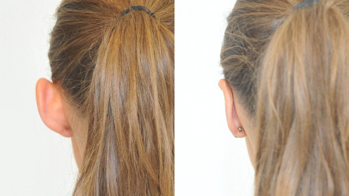 Ear surgery