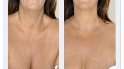 Mesotherapy